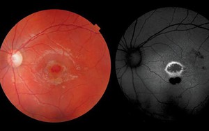 Nghịch chơi đèn laser, cậu bé bị thủng võng mạc