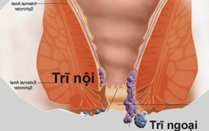 Những điều cần biết về bệnh trĩ: Lưu ý 2 việc tuyệt đối không làm