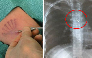 Que tránh thai "đi lạc" lên tim, phổi: Chuyên gia sản khoa Việt lý giải nguyên nhân