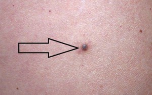 Chuyên gia hướng dẫn cách kiểm tra nốt ruồi trên cơ thể có khả năng gây ung thư hay không