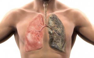 6 dấu hiệu không ngờ cảnh báo bệnh phổi đang tiến triển âm thầm bên trong cơ thể