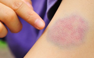 Vết bầm tím trên da: Có thể tự chữa ở nhà nhưng có lúc nên cảnh giác với những bệnh sau