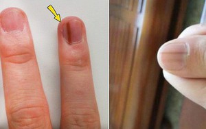 7 dấu hiệu cảnh báo bệnh nguy hiểm biểu hiện trên bàn tay của bạn