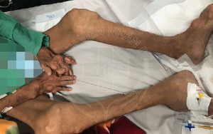 Uống thuốc giảm đau 10 năm liền, người đàn ông bị suy thận nặng, tay chân biến dạng