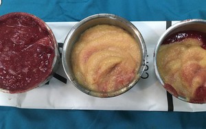 Rút cả lít hóa chất lạ trong ngực nữ Việt kiều