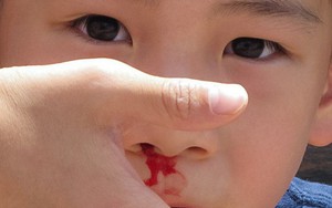 Cảnh báo: Trẻ bị chảy máu cam có thể nguy hiểm tính mạng nếu cứ ngửa đầu ra sau