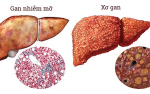 'Chất độc' gây hại cho gan nhiều người Việt lạm dụng hàng ngày