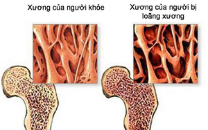 Bác sĩ xương khớp cảnh báo: Nhiều người Việt mắc chứng bệnh này xương chẳng khác gì gỗ mục