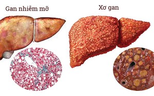 170 triệu người mắc căn bệnh nguy hiểm, dễ lây nhiễm gấp 10 lần HIV: Phòng ngừa thế nào?