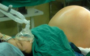 Bác sĩ chẩn đoán từ mang song thai thành 4 thai, sản phụ đi đẻ trong sự ngỡ ngàng của người nhà và bác sĩ