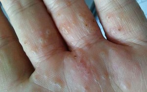 Ghẻ nước, căn bệnh rất dễ mắc trong thời tiết hiện nay và đây là cách phòng tránh