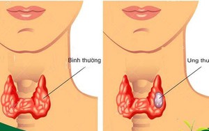6 dấu hiệu cảnh báo ung thư tuyến giáp sớm nhất: Cơ hội sống gần 100% vì điều trị kịp thời