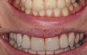 Răng hỏng vì chọn sai kem đánh răng: Chuyên gia khuyến cáo 3 việc hại răng không nên làm