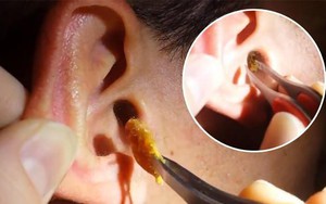Người đàn ông thủng màng nhĩ vì lấy ráy tai ở tiệm cắt tóc: BS khuyến cáo các nguy cơ