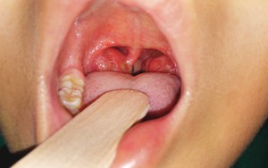 Lúc nào cũng nghe 'tiếng ve sầu' – dấu hiệu không ngờ của bệnh ung thư rất nguy hiểm