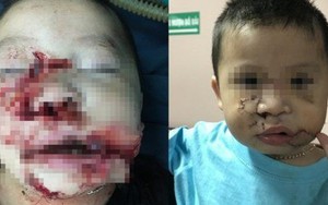 Hà Nội: Lại thêm người bị chó nhà cắn rách nát môi, lóc da bàn tay