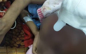 Đắp thuốc trôi nổi, mụn nhỏ thành khối u ác tính che kín mặt bé trai