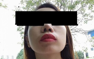 Bỏ 30 triệu đồng phẫu thuật thẩm mỹ, cô gái đau đớn bị lệch mũi