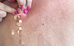 Điều gì xảy ra khi nặn cục mụn có tuổi đời 25 năm trên lưng một người đàn ông?