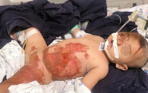 Bé gái 20 tháng tuổi bị lột tróc da do bỏng nước sôi