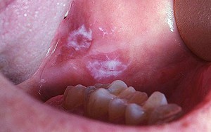 10 bệnh thường gặp ở miệng: Cái số 5 và 6 có thể biến thành ung thư, ai cũng nên cảnh giác