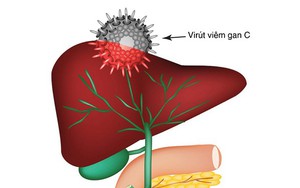 Viêm gan siêu vi C và các biến chứng thường gặp