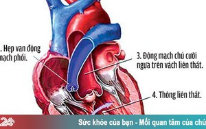 Những điều cần biết về bệnh tim bẩm sinh Tứ chứng Fallot