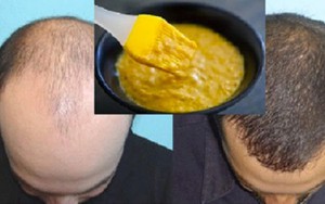 Mặt nạ giúp kích thích mọc tóc