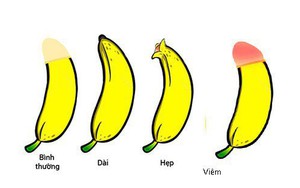 90% trẻ em có thể hẹp bao quy đầu, con bạn có bị hẹp không?