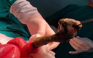 Mắc bệnh ăn tóc kỳ lạ, bé gái 6 tuổi tắc búi tóc to trong ruột