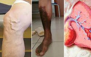 Đừng đùa với những đường gân "loằng ngoằng", không cẩn thận có thể biến chứng vào tim, phổi