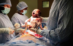Cuối cùng thì cũng đã tìm ra lý do vì sao bé sinh mổ hay quấy khóc hơn bé sinh thường