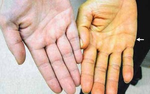 Bác sĩ Bệnh viện K chia sẻ các dấu hiệu "vàng" cảnh báo bệnh ung thư gan