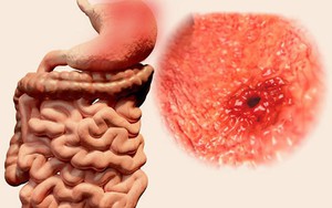 7 triệu chứng ung thư sớm không gây đau: Chỉ cần có 1 triệu chứng là bạn phải đi khám ngay