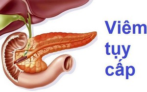 4 dấu hiệu sớm nhất của viêm tụy cấp - căn bệnh diễn biến nhanh và rất nguy hiểm