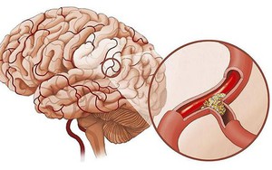 5 dấu hiệu của thiếu máu não: Dễ nhầm với bệnh khác nên nhiều người tử vong trong tích tắc