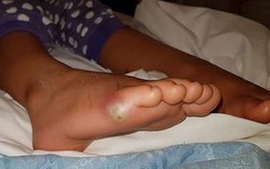 Bé gái 4 tuổi nhiễm trùng máu vì... thử giày mà không đi tất