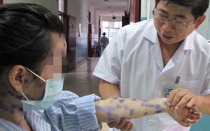 Bệnh thủy đậu tăng mạnh gần 39.000 ca mắc, phòng bệnh cách nào?