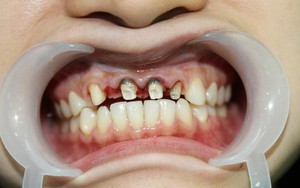 Bọc răng sứ không đảm bảo chất lượng, bạn phải đối mặt với những nguy cơ không ngờ
