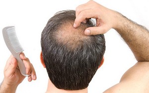 Hơn cả béo phì, người hói đầu có nguy cơ mắc bệnh tim mạch cao gấp 5 lần