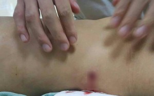 Đi làm ruộng, người đàn ông bất ngờ bị đạn găm vào đùi