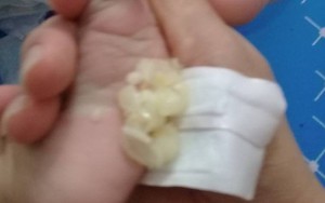 Bài thuốc chữa ho, cảm, sổ mũi bằng củ hành tăm được nhiều mẹ bỉm sữa "tung hô" thực hư như nào?