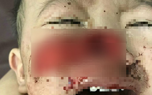 Hãi hùng bé trai bị chó cắn đứt rời... mũi