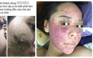 Khuôn mặt đáng sợ của cô gái khiến chị em dè chừng với mỹ phẩm không rõ nguồn gốc