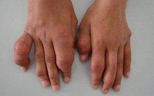 Hóa giải nỗi lo gút mạn tính nhờ Hoàng Tiên Đan