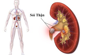 Bệnh nhân mổ sỏi thận 6 lần vẫn tái phát, bác sĩ "hoảng" tìm ra bệnh hiếm