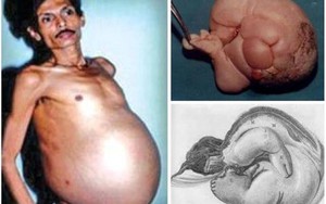 Chuyện lạ về người đàn ông mang thai suốt 36 năm ở Ấn Độ