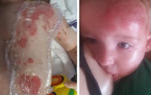 Bé bị bỏng nặng vì bát mì vừa lấy ra từ lò vi sóng nhưng sự nhanh trí của mẹ đã cứu nguy cho con