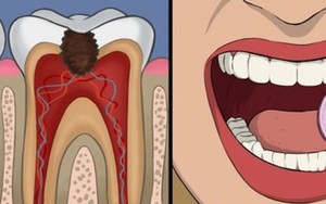 11 cách giúp bạn dịu cơn đau do mọc răng khôn