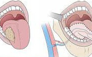 Dấu hiệu ung thư lưỡi mà bạn dễ dàng bỏ qua